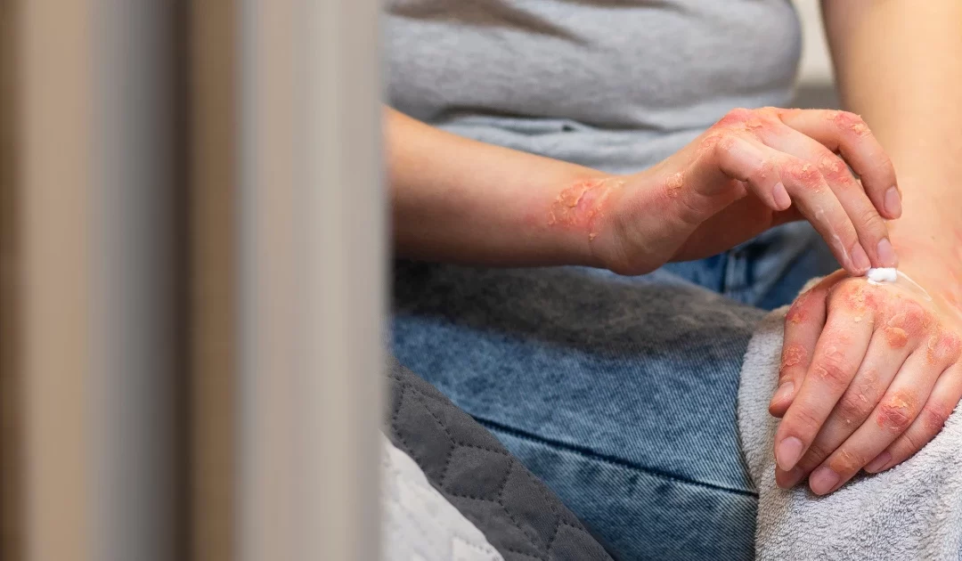 Não demore muito pra solicitar exame ou tratar sífilis