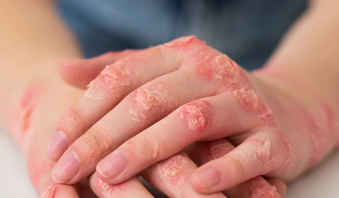 Sífilis Congênita: Entenda O Que É e Como Se Tratar