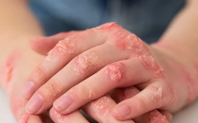 Sífilis Congênita: Entenda O Que É e Como Se Tratar